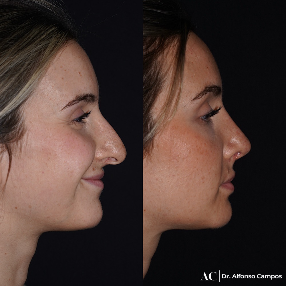 Mejor cirujano de rinoplastia en Madrid: cómo elegir sin equivocarte